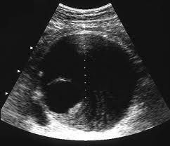 Figure 1. Ultrasonographic picture of AAA