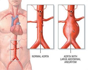 Figure 3. Illustrating common site of  Abdominal Aortic Aneurysm