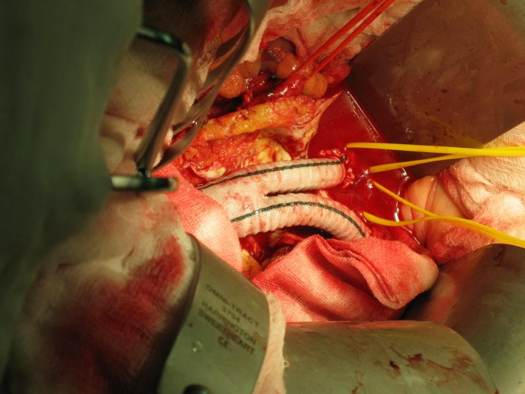 Figure 6: Intra-op picture of Inlay-graft